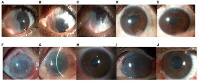 Mini-Review: Regenerating the Corneal Epithelium With Simple Limbal Epithelial Transplantation